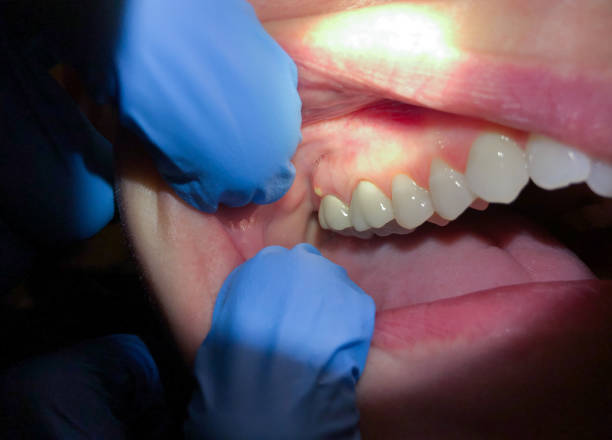Best Dentist for Tooth Abscess  in Marysville, OH